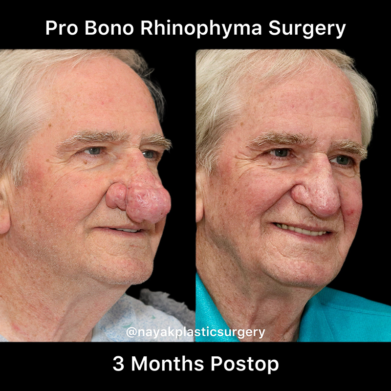 Rhinophyma Reduction Before & After Image