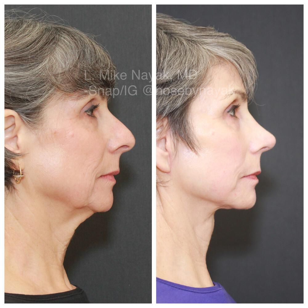 Facelift And Neck Lift Before & After