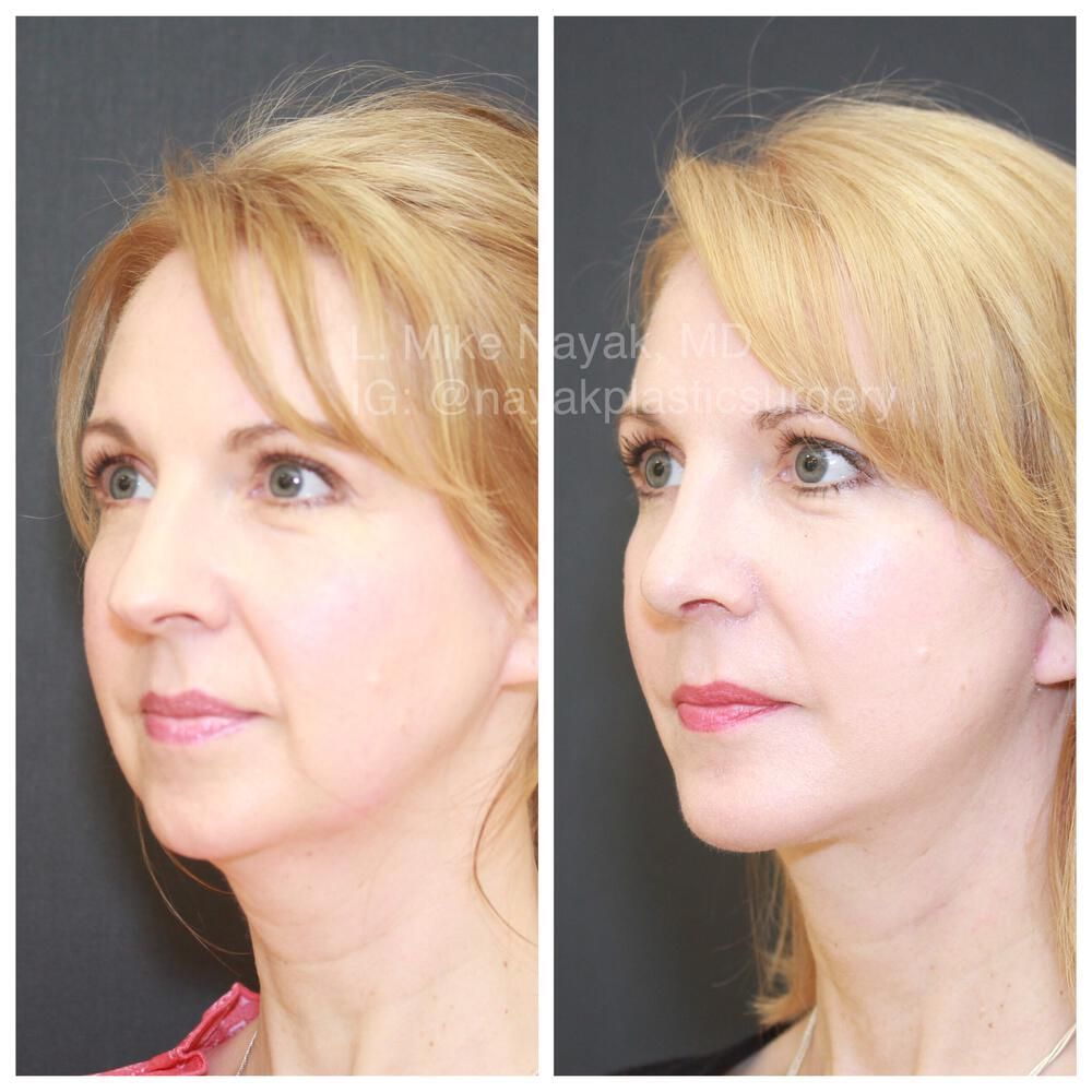 Facelift And Neck Lift Before & After