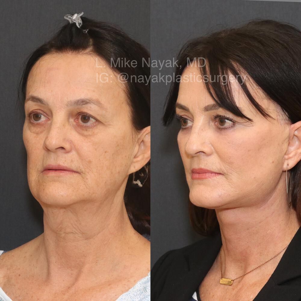 Facelift And Neck Lift Before & After