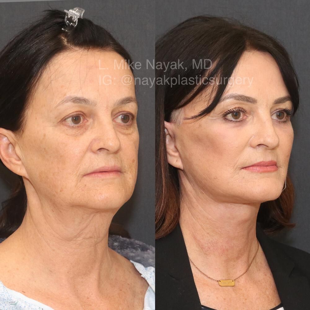 Facelift And Neck Lift Before & After