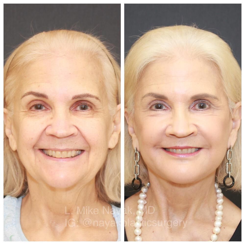 Facelift And Neck Lift Before & After