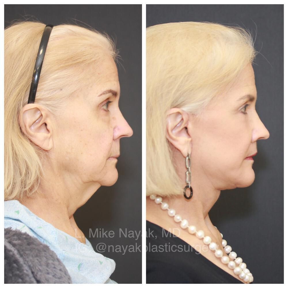 Facelift And Neck Lift Before & After