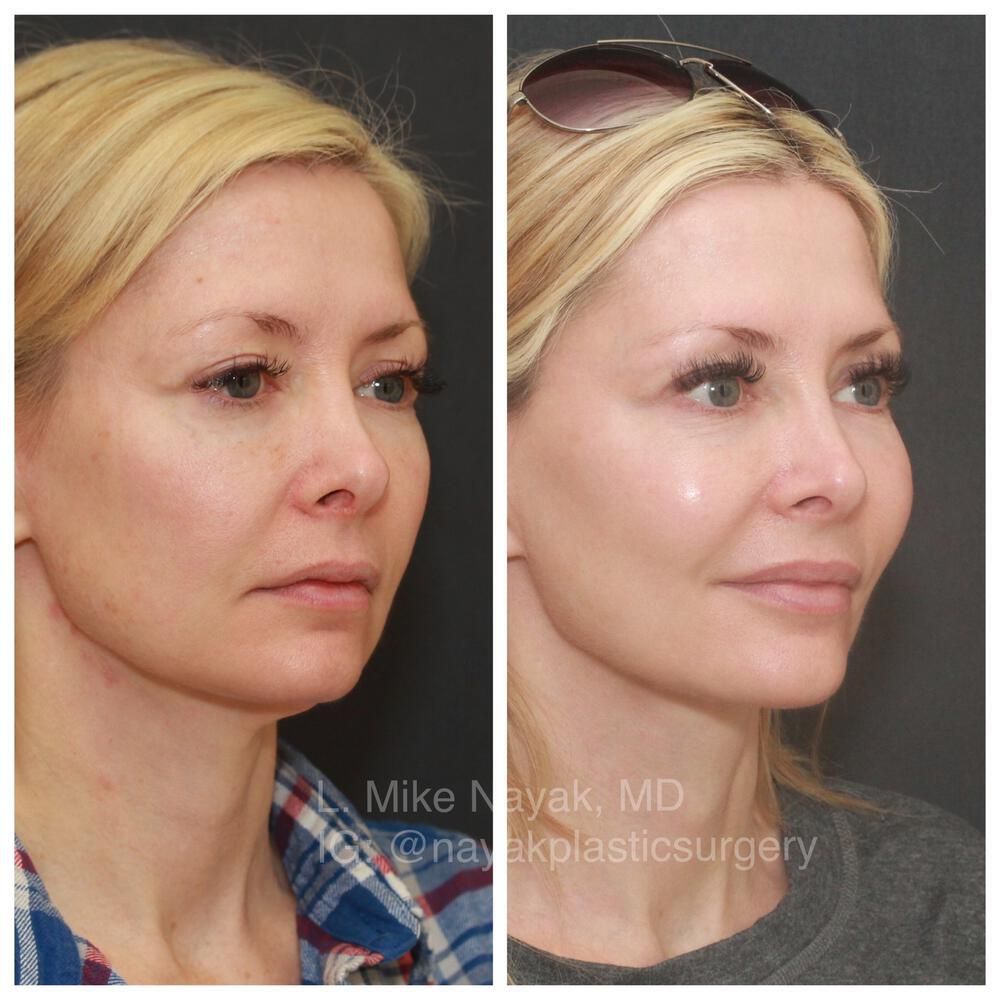 Facelift And Neck Lift Before & After