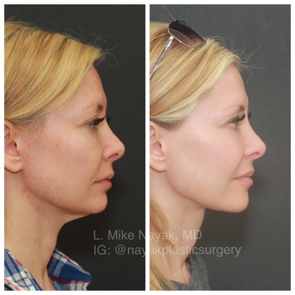 Facelift And Neck Lift Before & After