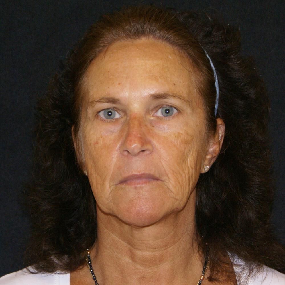 Facelift And Neck Lift Before & After