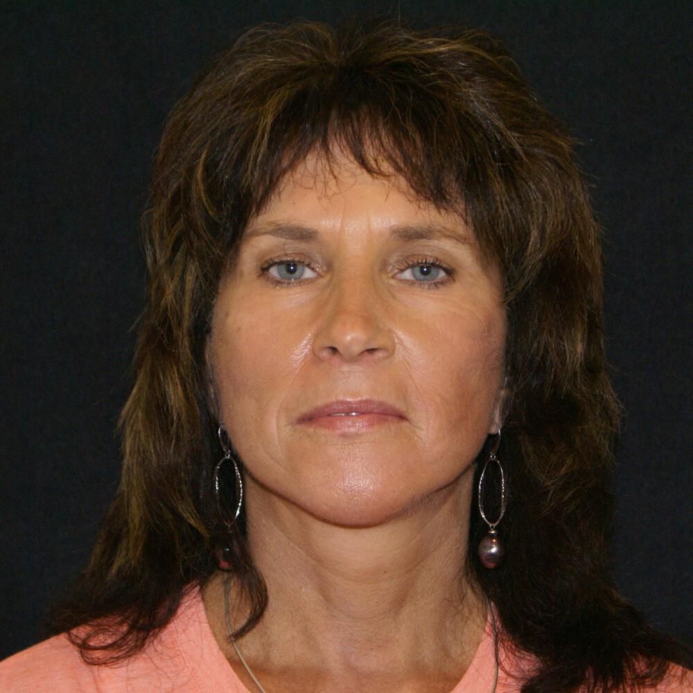 Facelift And Neck Lift Before & After