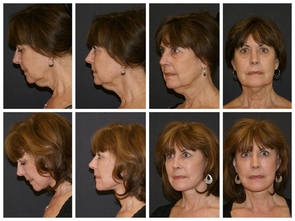 Facelift And Neck Lift Before & After