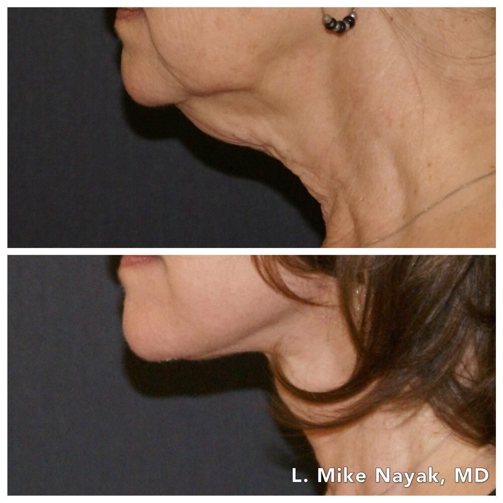 Facelift And Neck Lift Before & After