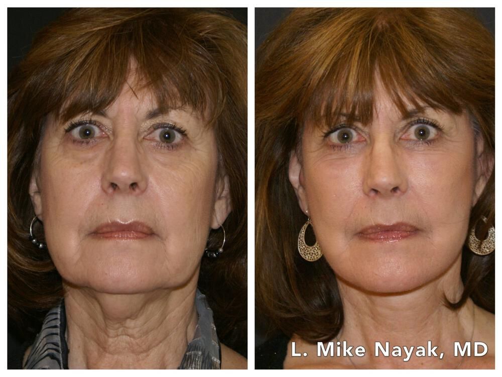 Facelift And Neck Lift Before & After