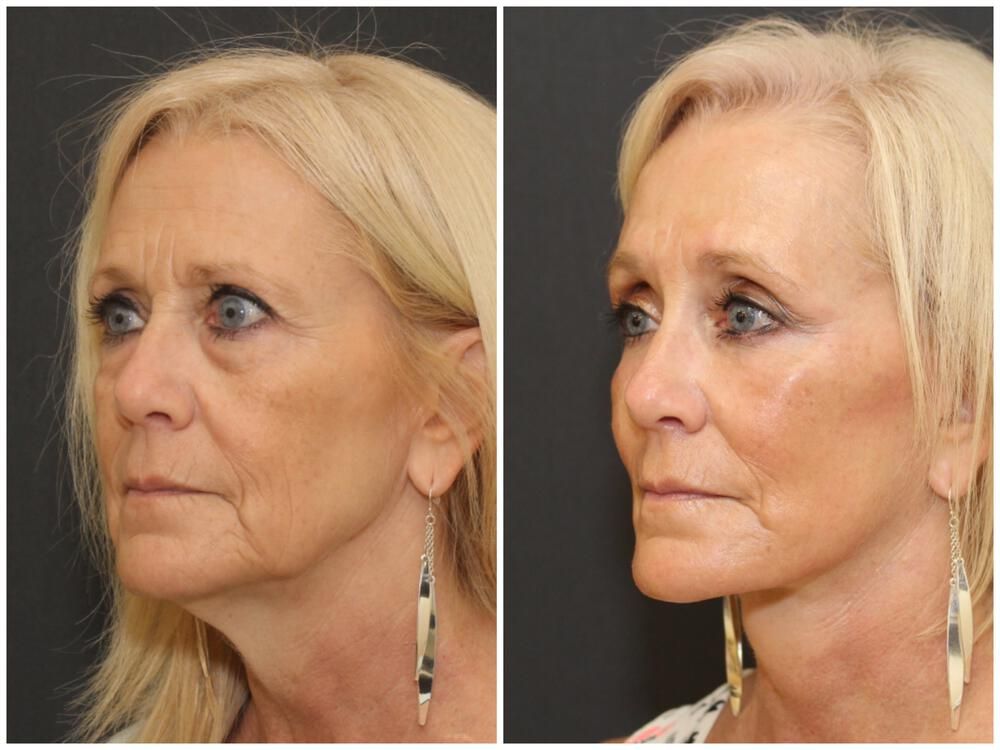 Facelift And Neck Lift Before & After