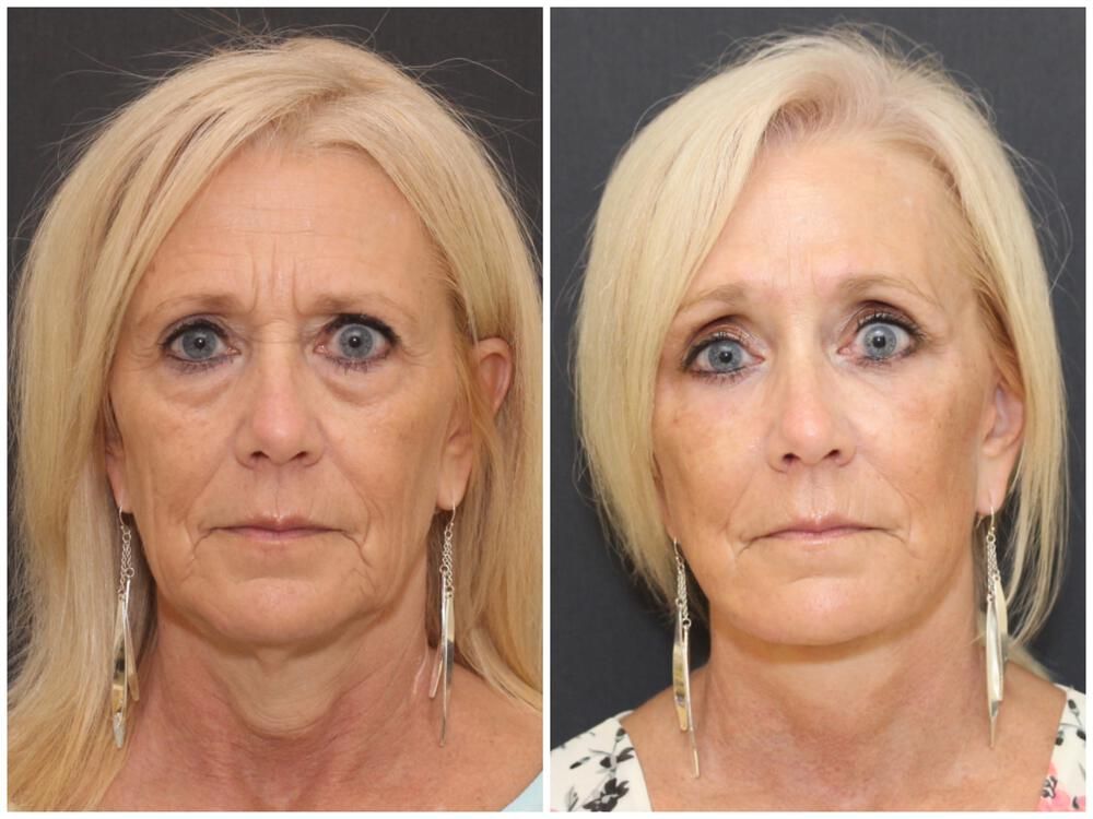 Facelift And Neck Lift Before & After