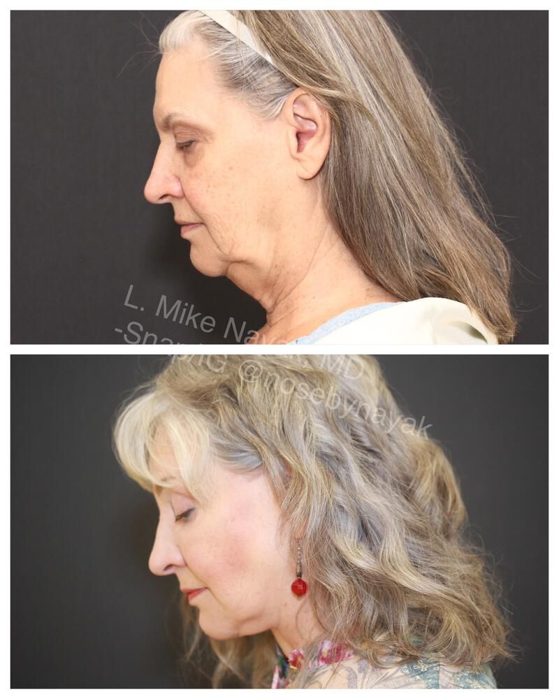 Facelift And Neck Lift Before & After