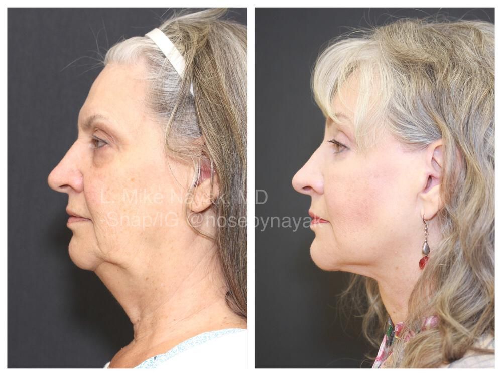 Facelift And Neck Lift Before & After