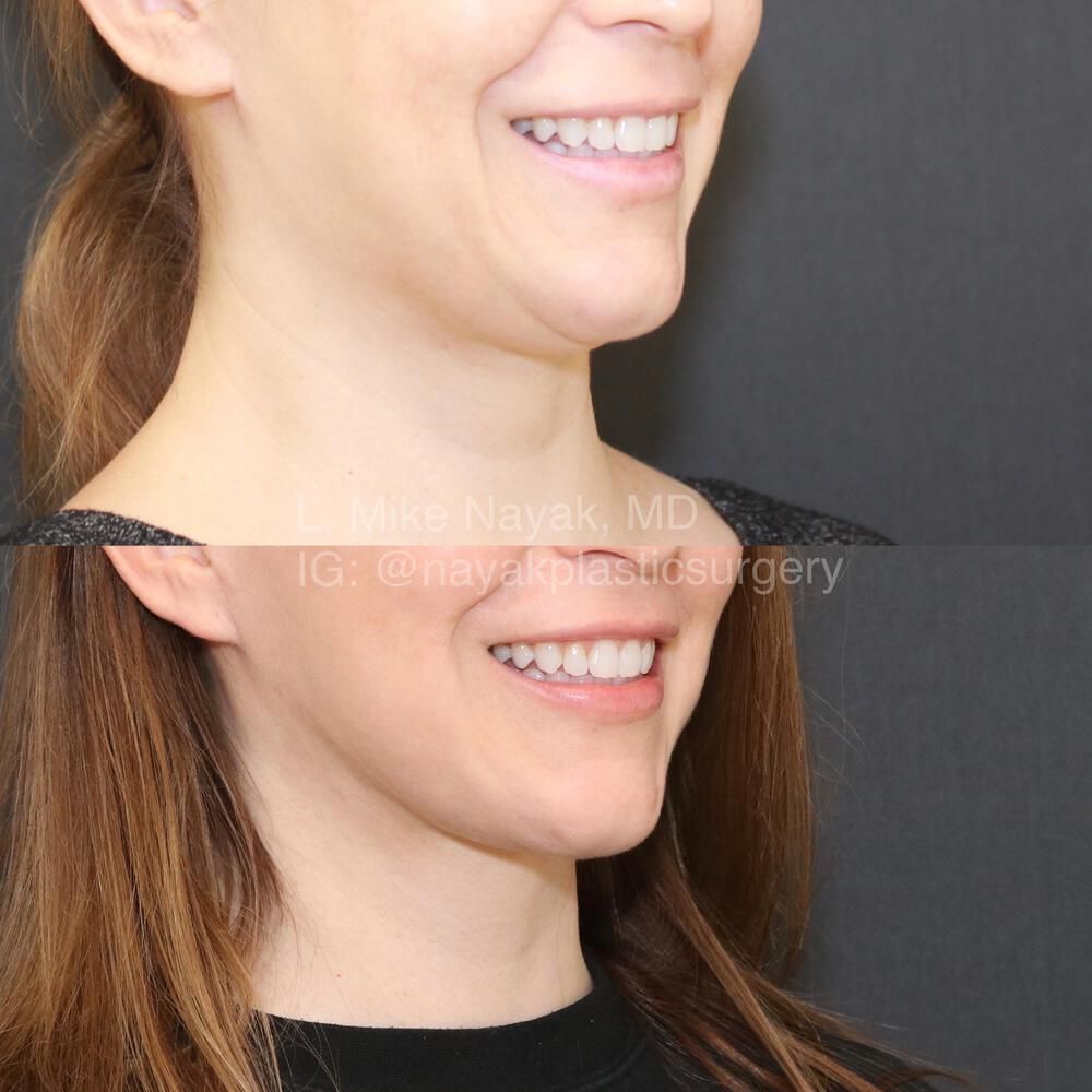 Facelift And Neck Lift Before & After