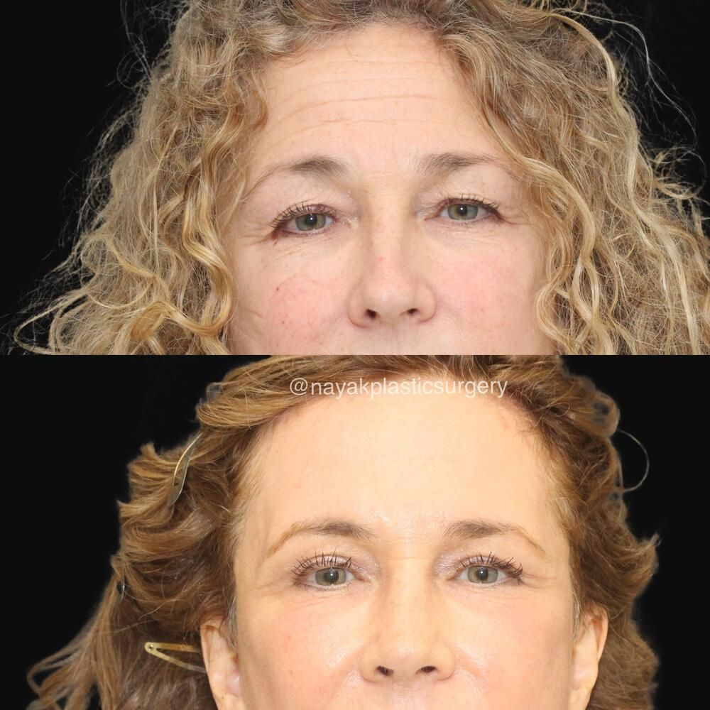 Facelift And Neck Lift Before & After