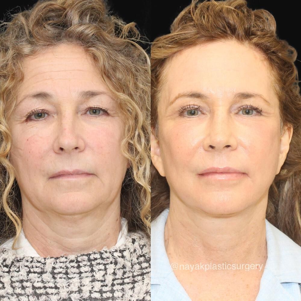 Facelift And Neck Lift Before & After