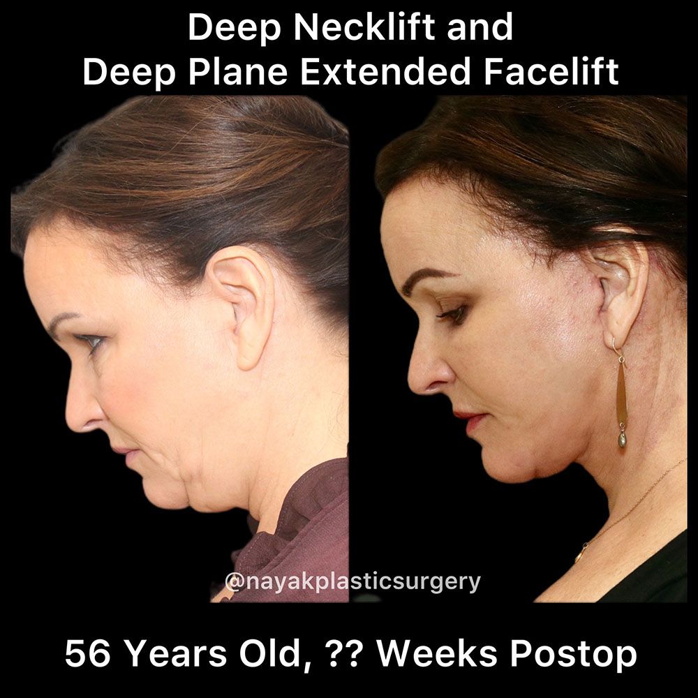Facelift And Neck Lift Before & After