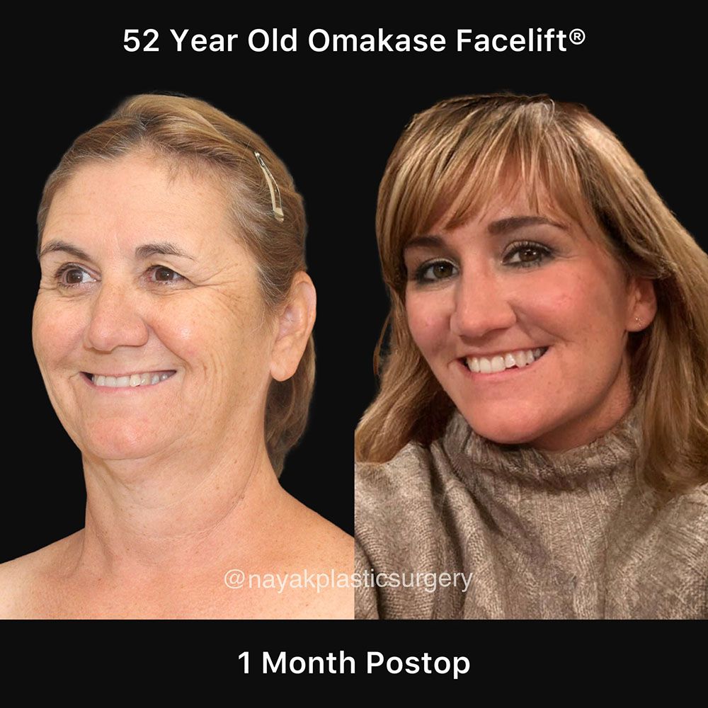 Facelift And Neck Lift Before & After