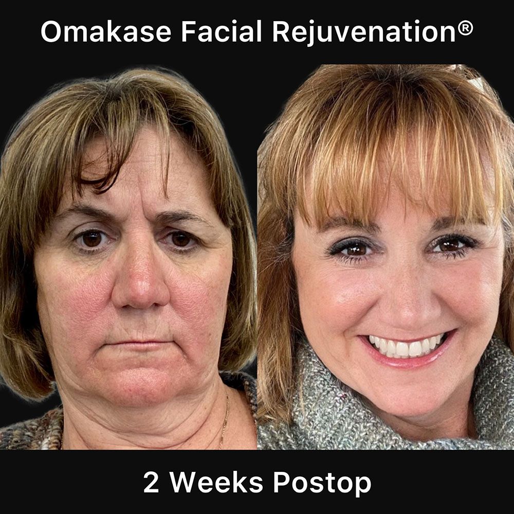 Facelift And Neck Lift Before & After
