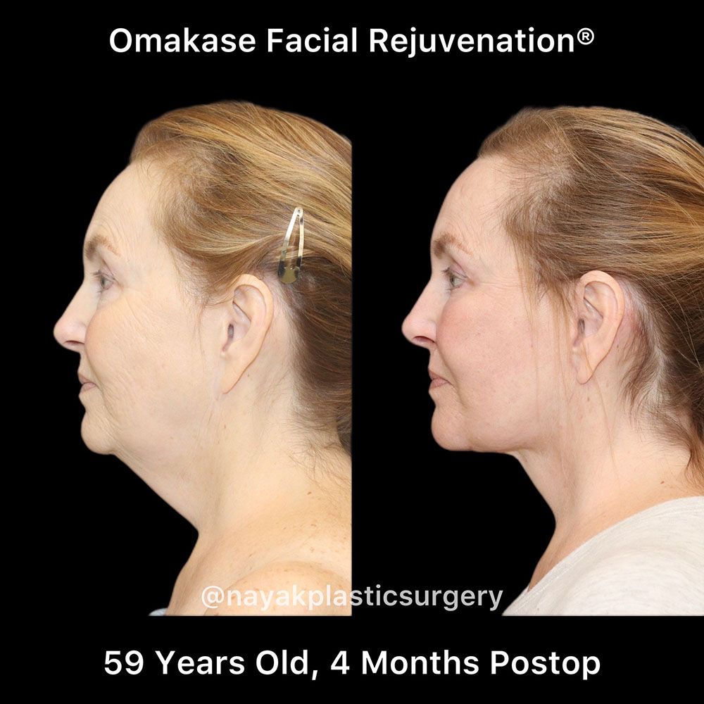Facelift And Neck Lift Before & After