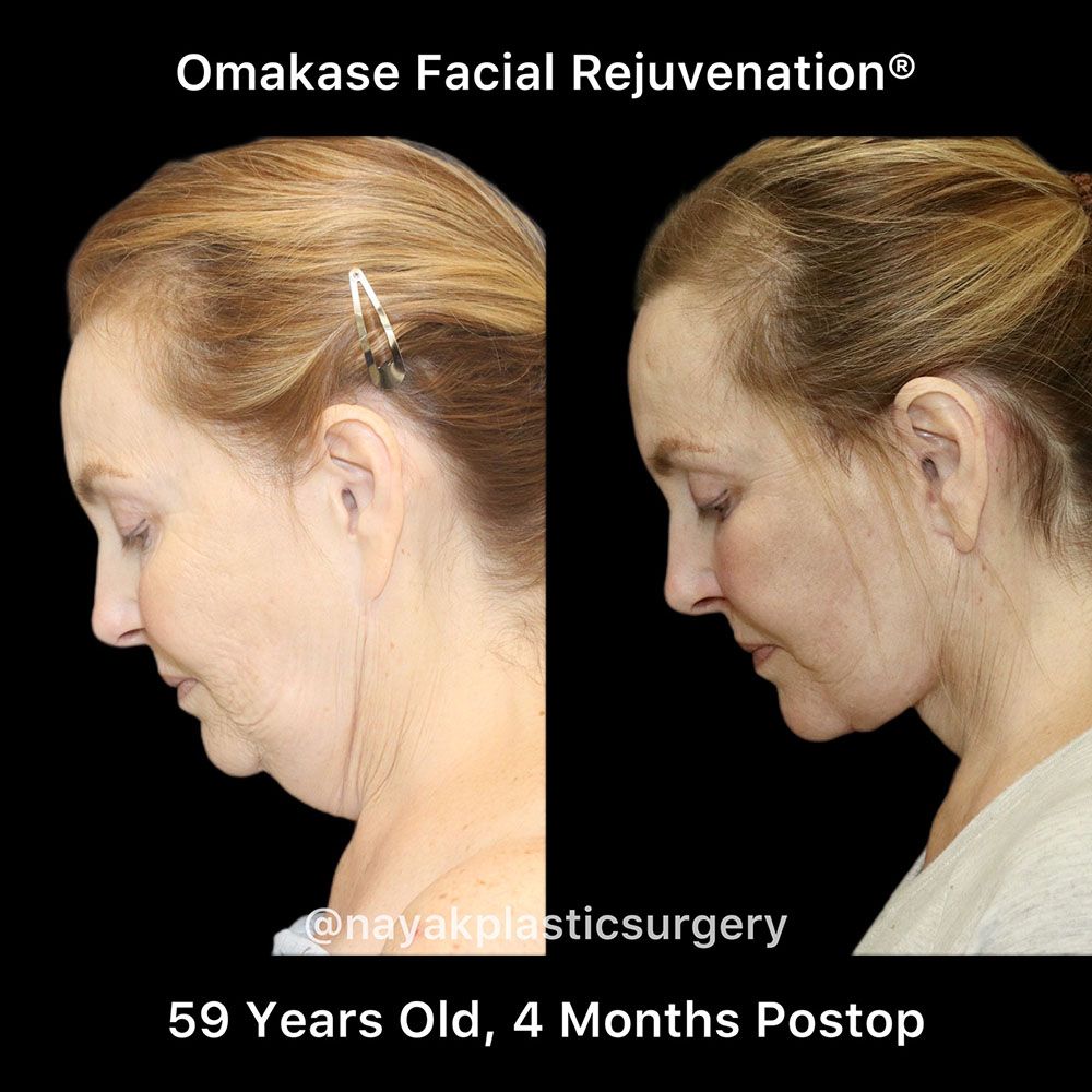 Facelift And Neck Lift Before & After