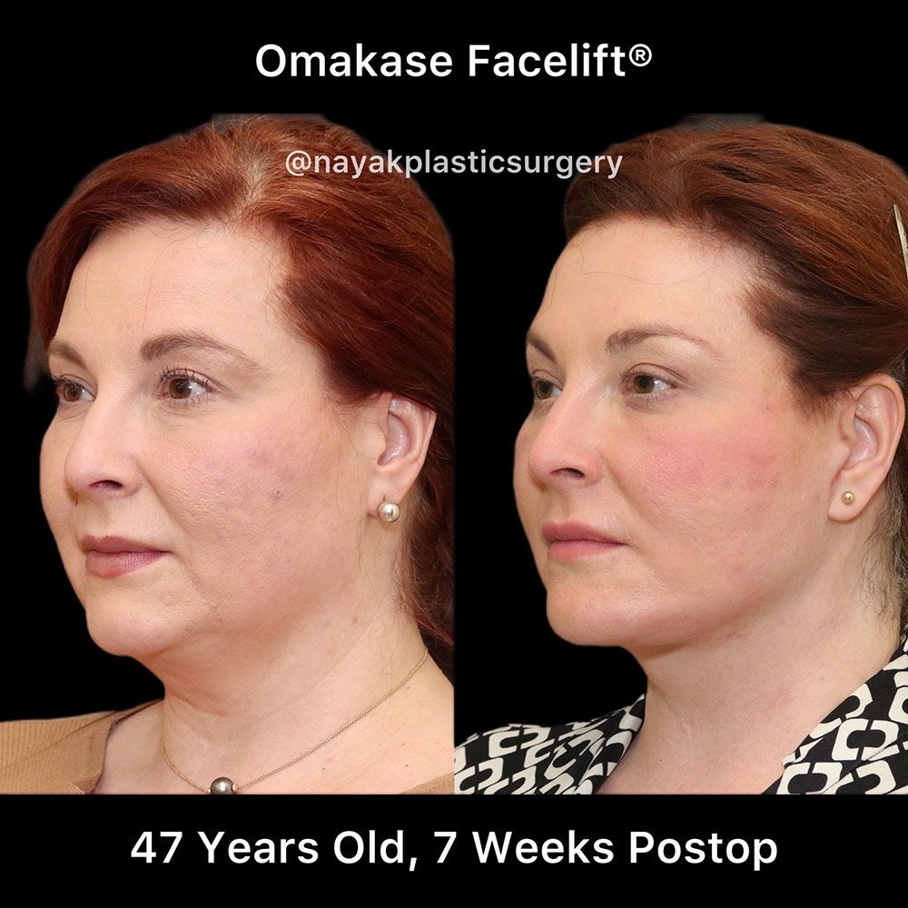 Facelift And Neck Lift Before & After