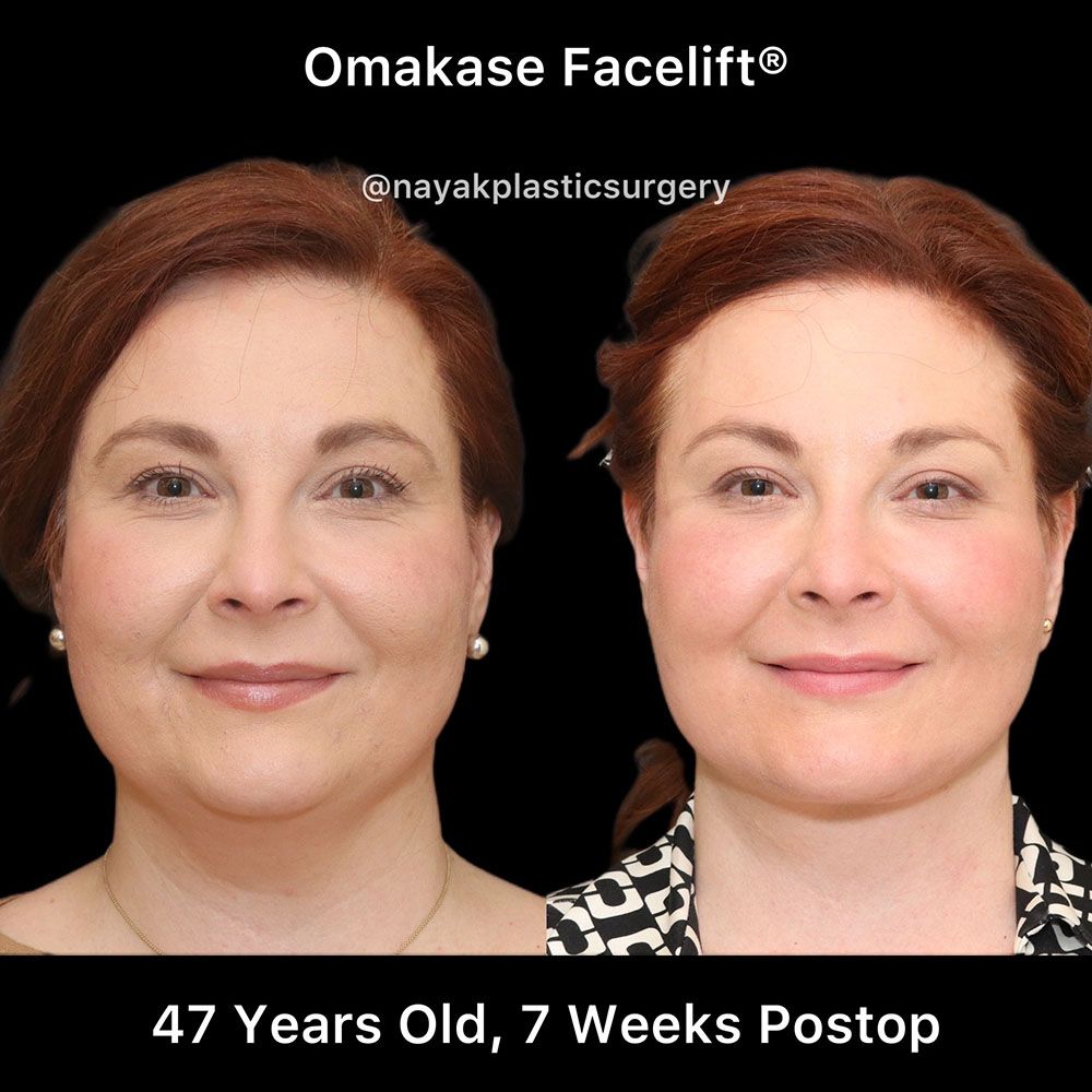 Facelift And Neck Lift Before & After