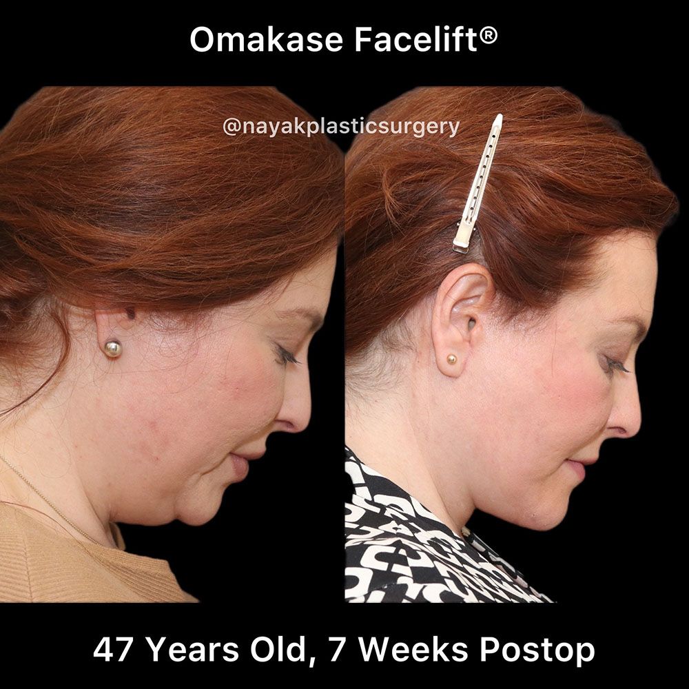 Facelift And Neck Lift Before & After