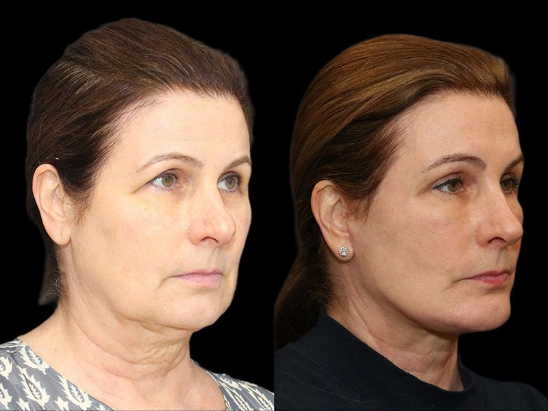 Facelift And Neck Lift Before & After