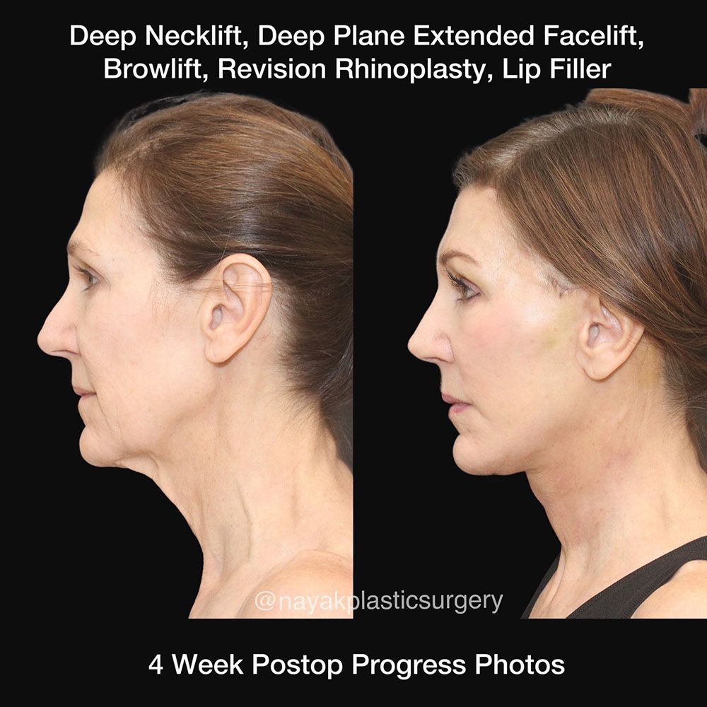 Facelift And Neck Lift Before & After