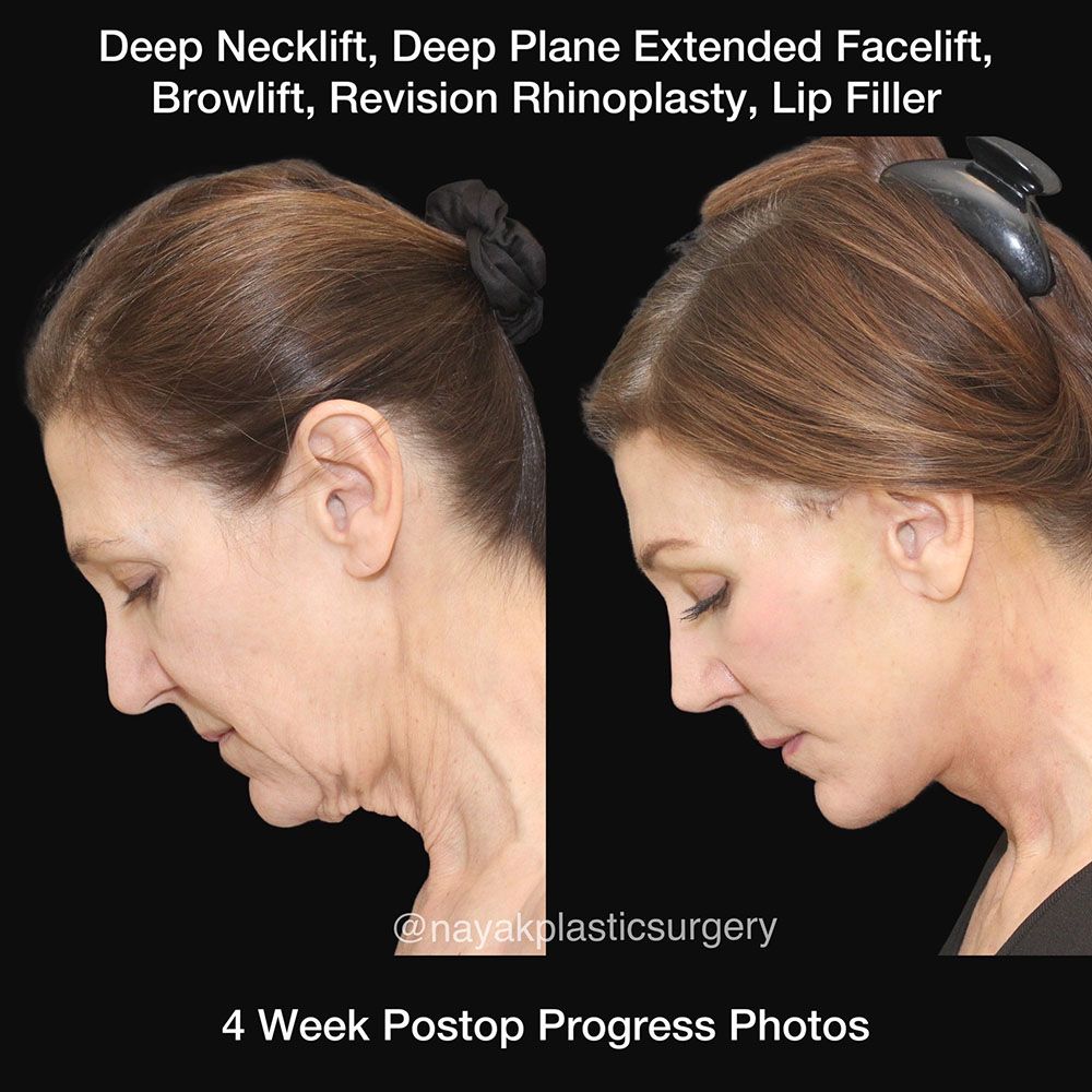 Facelift And Neck Lift Before & After