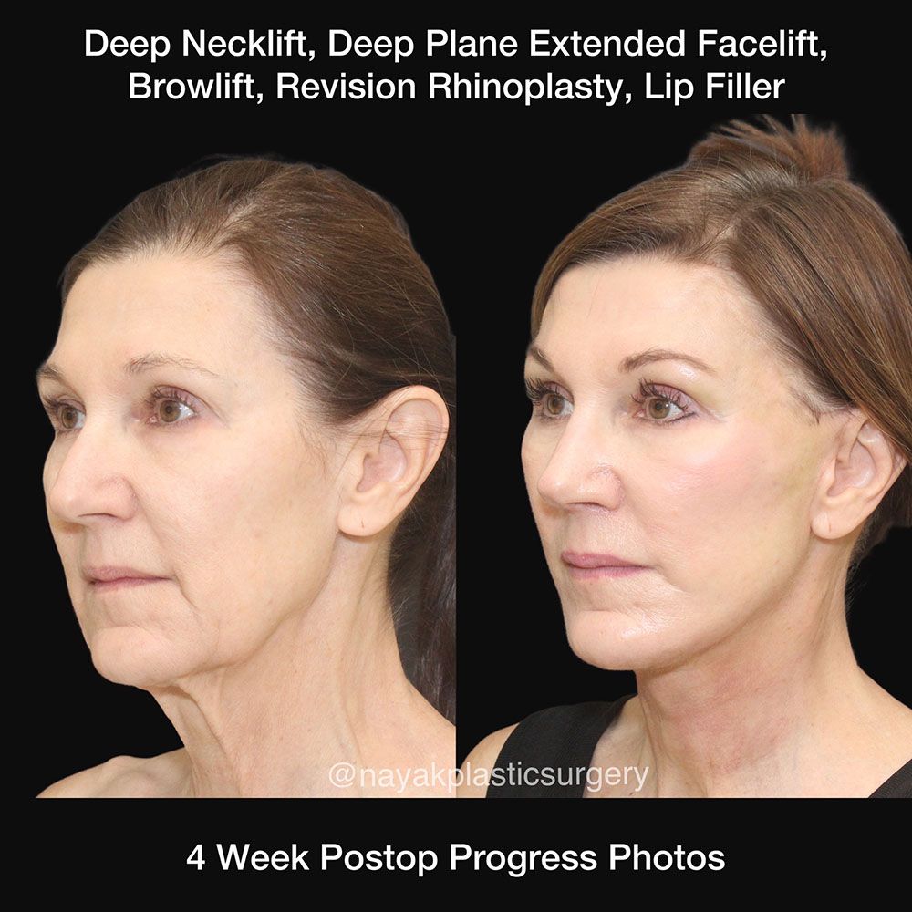 Facelift And Neck Lift Before & After