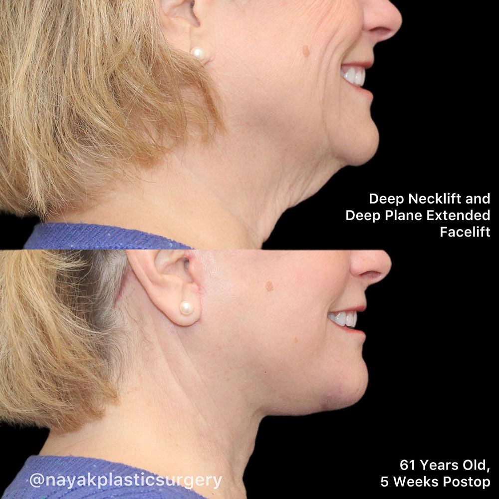 Facelift And Neck Lift Before & After
