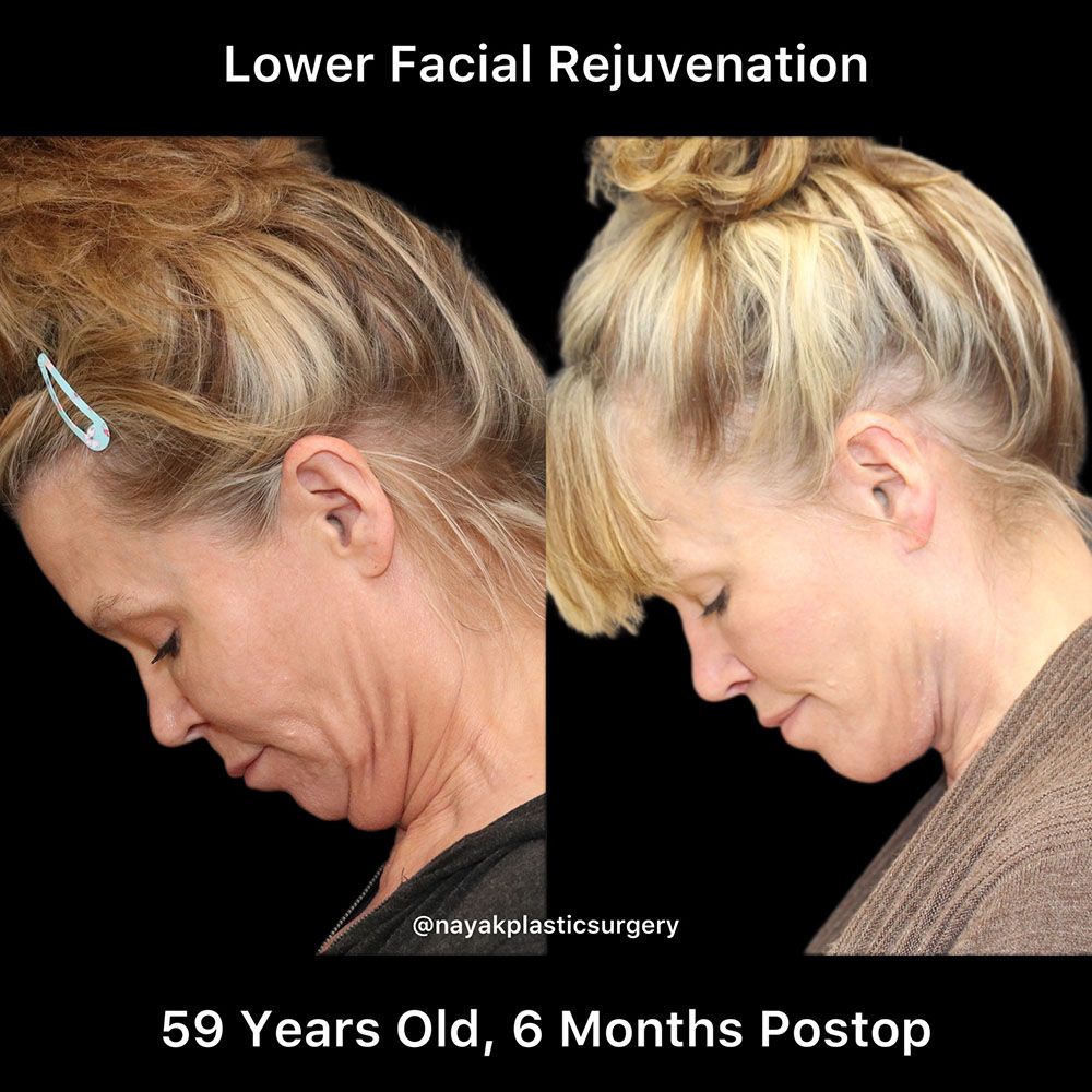 Facelift And Neck Lift Before & After