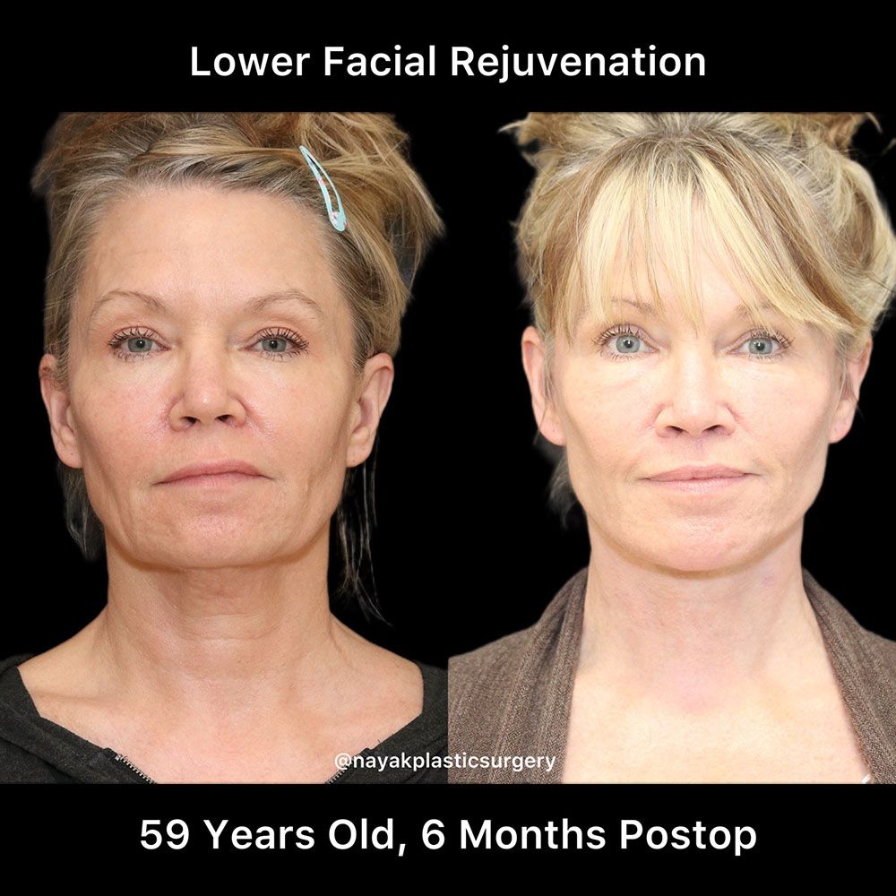 Facelift And Neck Lift Before & After
