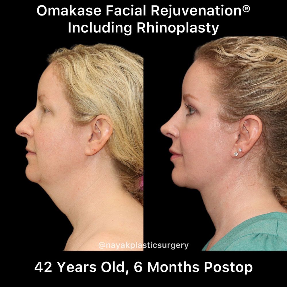 Facelift And Neck Lift Before & After