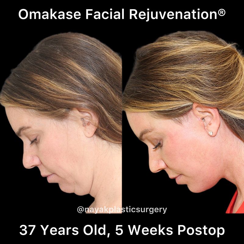 Facelift And Neck Lift Before & After
