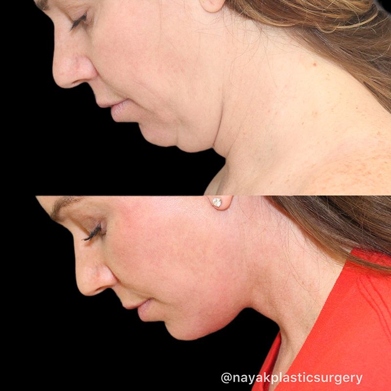 Facelift And Neck Lift Before & After
