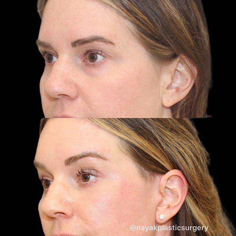 Facelift And Neck Lift Before & After