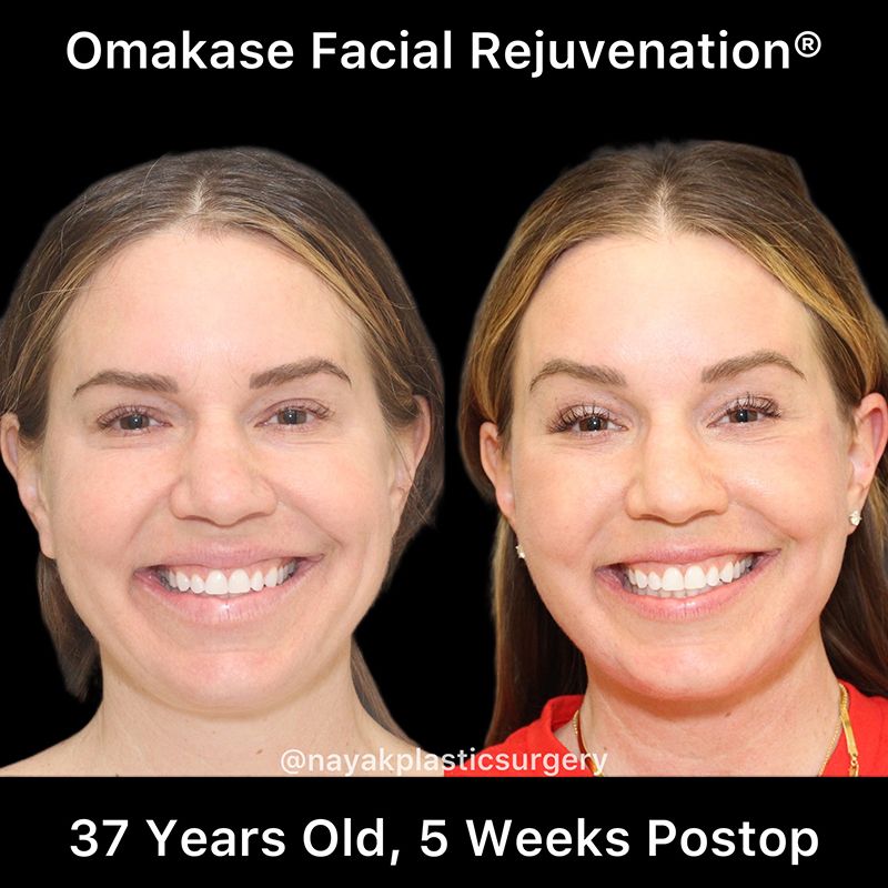 Facelift And Neck Lift Before & After