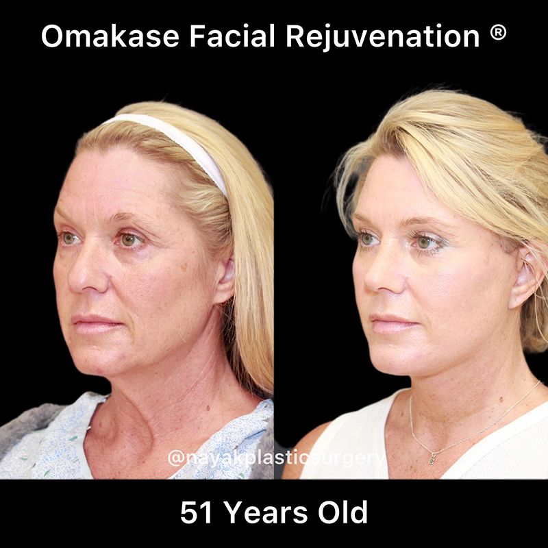 Facelift And Neck Lift Before & After