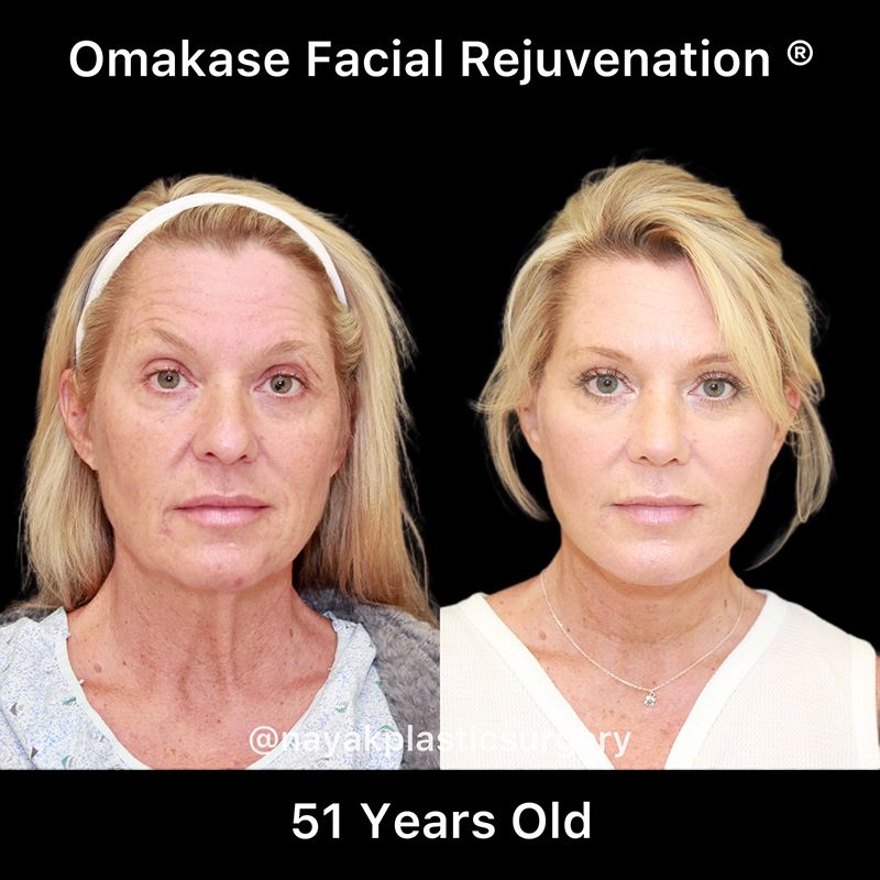 Facelift And Neck Lift Before & After
