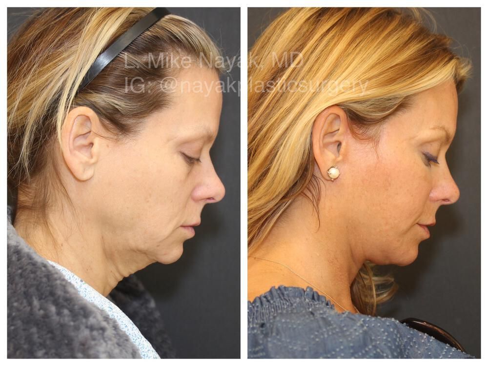 Brow Lift Before & After