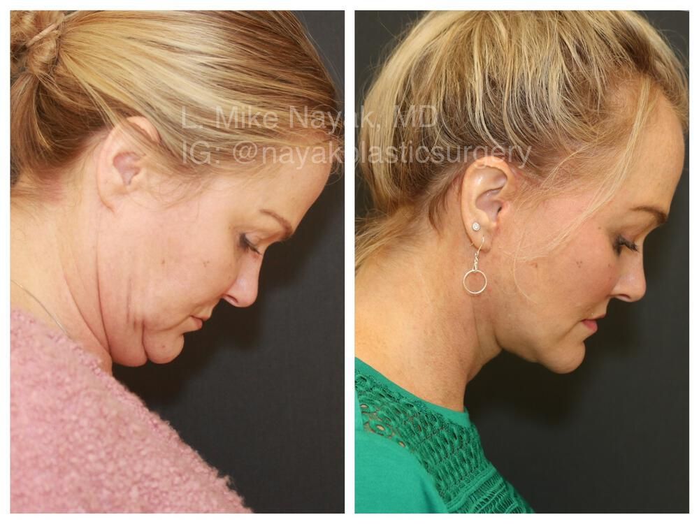 Brow Lift Before & After