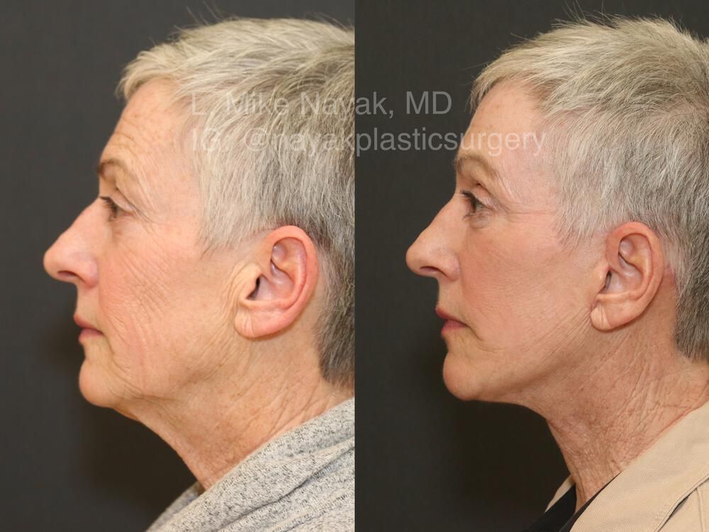 Brow Lift Before & After