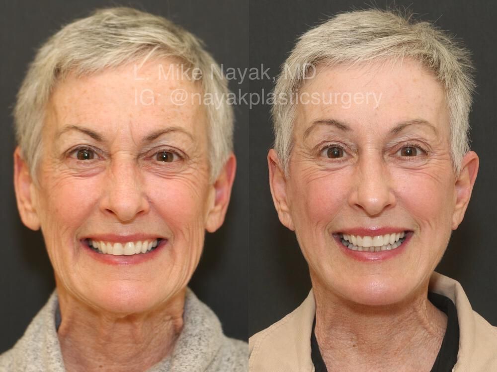 Brow Lift Before & After