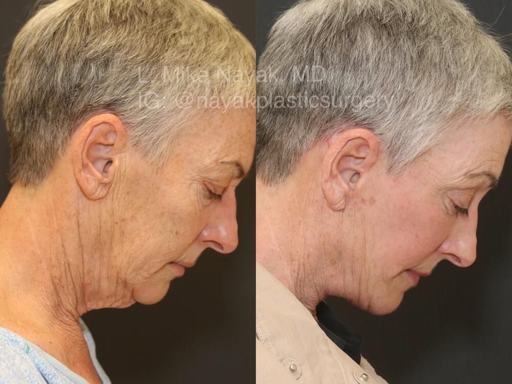 Brow Lift Before & After