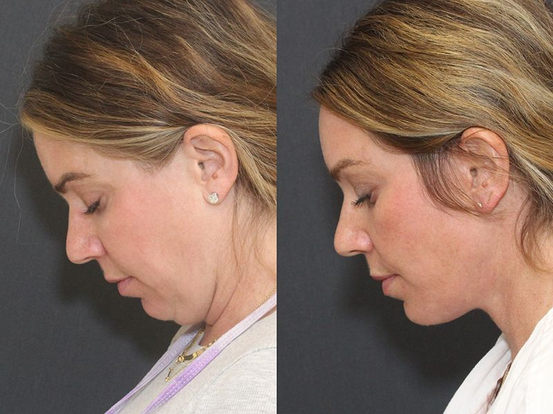 Brow Lift Before & After