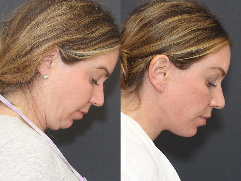 Brow Lift Before & After